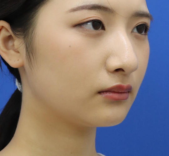 20代女性の顔の脂肪吸引  Before 症例写真