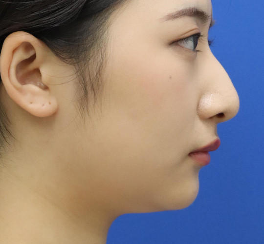 20代女性の顔の脂肪吸引  Before 症例写真