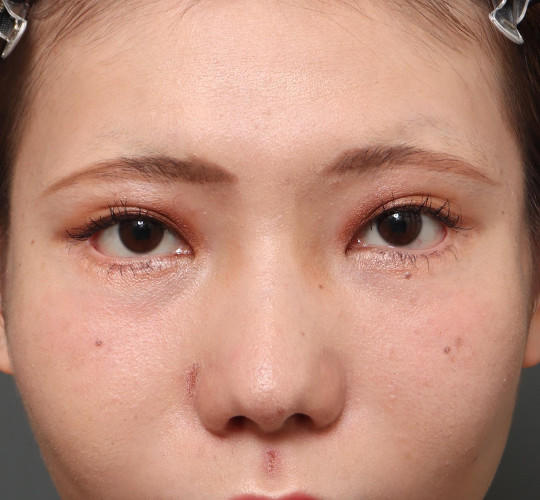 20代女性のタレ目・でか目形成 After 症例写真