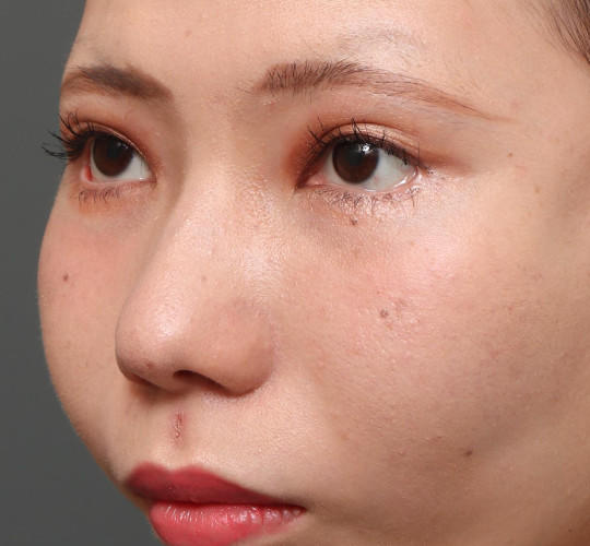 20代女性のタレ目・でか目形成 After 症例写真