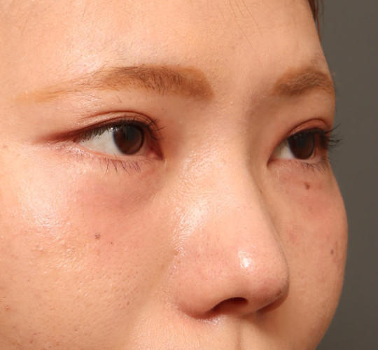 20代女性のタレ目・でか目形成 Before 症例写真