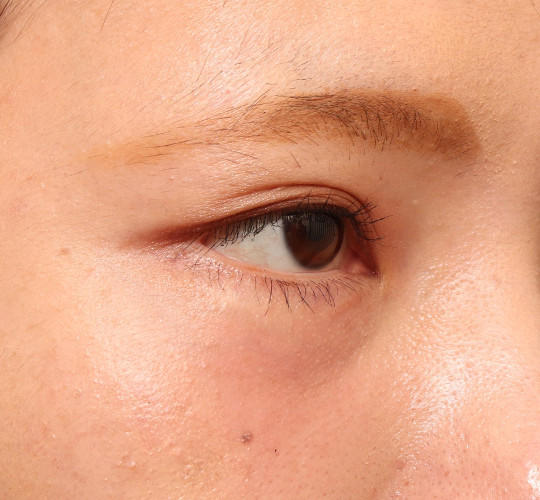 20代女性のタレ目・でか目形成 Before 症例写真