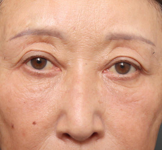 60代女性の真皮線維芽細胞療法 After 症例写真