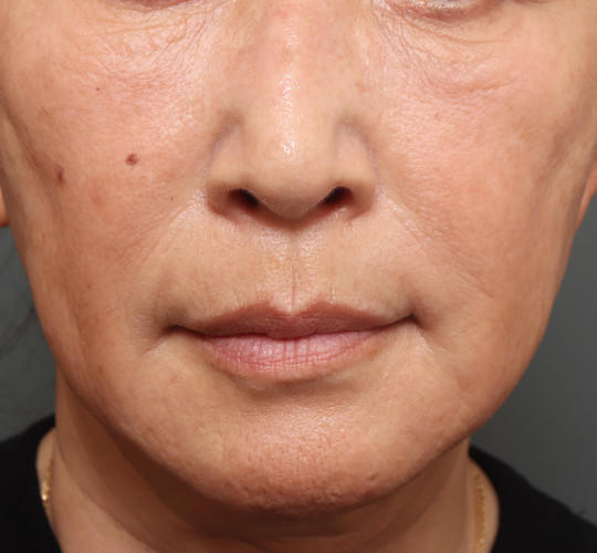 60代女性の真皮線維芽細胞療法 After 症例写真