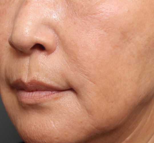 60代女性の再生医療（顔） After 症例写真