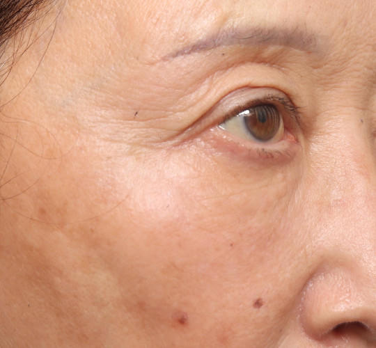 60代女性の真皮線維芽細胞療法 After 症例写真