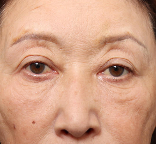 60代女性の真皮線維芽細胞療法 Before 症例写真