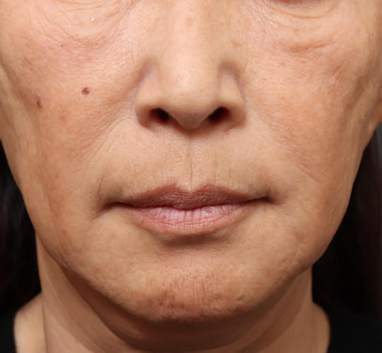 60代女性の真皮線維芽細胞療法 Before 症例写真