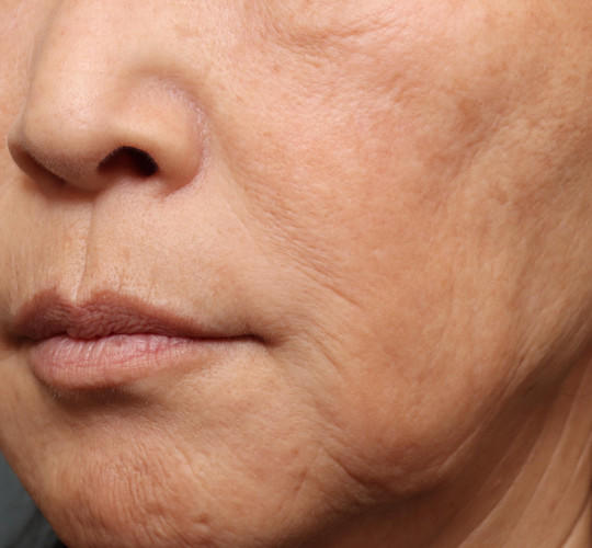 60代女性の再生医療（顔） Before 症例写真