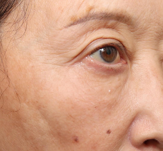 60代女性の真皮線維芽細胞療法 Before 症例写真