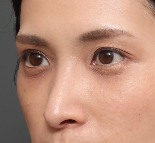 30代女性の3Dリポアイリフト  After 症例写真