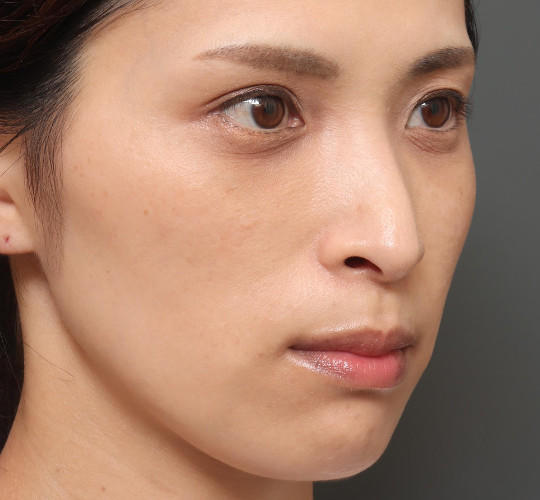 30代女性の3Dリポアイリフト  After 症例写真