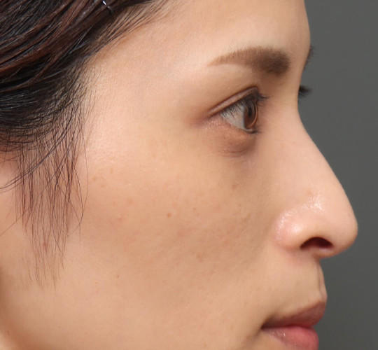 30代女性の3Dリポアイリフト  After 症例写真