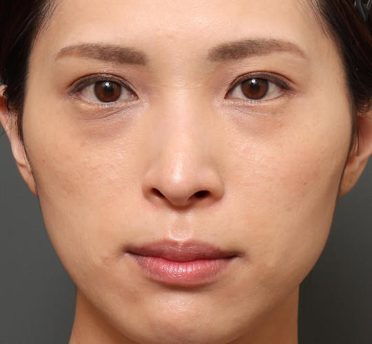 30代女性の目の下のクマ治療 Before 症例写真