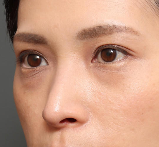 30代女性の3Dリポアイリフト  Before 症例写真