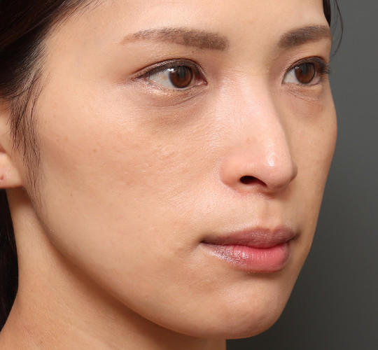 30代女性の3Dリポアイリフト  Before 症例写真