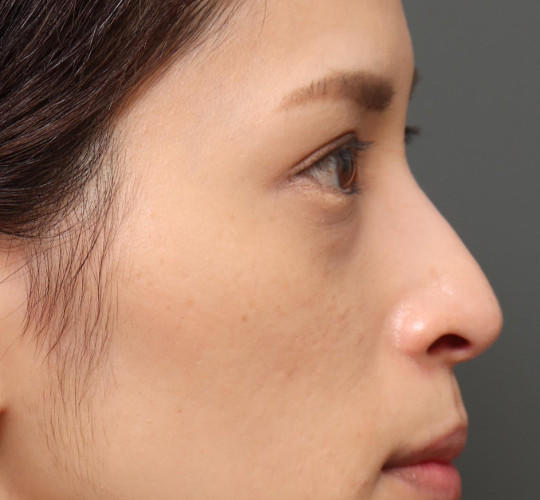 30代女性の3Dリポアイリフト  Before 症例写真