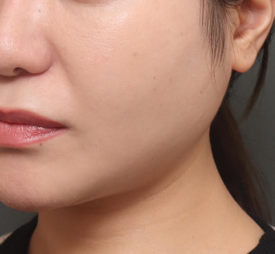 20代女性の顔の脂肪吸引  After 症例写真