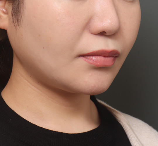 20代女性の顔の脂肪吸引 After 症例写真