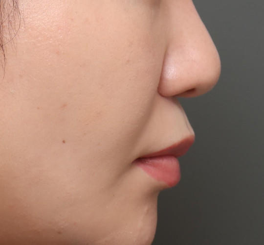 20代女性の顔の脂肪吸引  After 症例写真