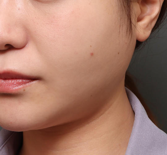 20代女性の顔の脂肪吸引  Before 症例写真