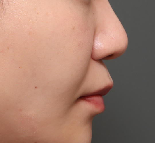 20代女性の顔の脂肪吸引  Before 症例写真