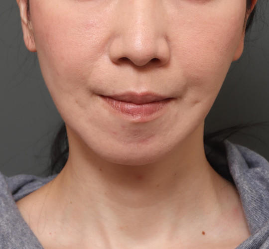 40代女性のチークリフト・フェイスリフト After 症例写真