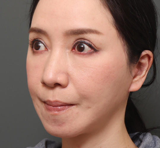 40代女性のチークリフト・フェイスリフト After 症例写真