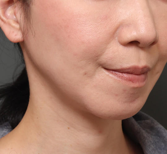 40代女性のチークリフト・フェイスリフト After 症例写真