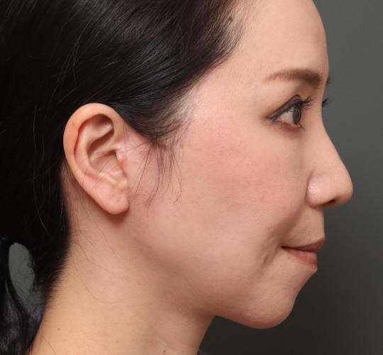 40代女性のチークリフト・フェイスリフト After 症例写真