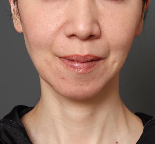 40代女性のチークリフト・フェイスリフト Before 症例写真