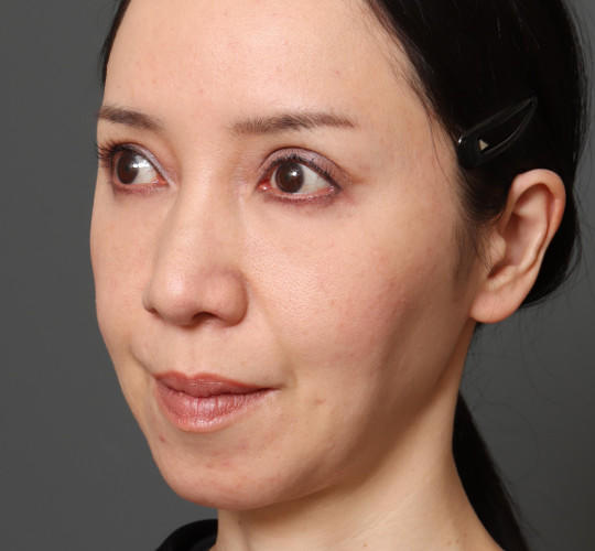 40代女性のチークリフト・フェイスリフト Before 症例写真
