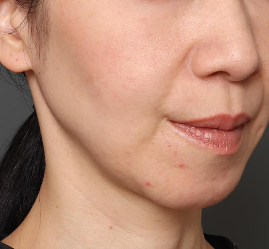 40代女性のチークリフト・フェイスリフト Before 症例写真