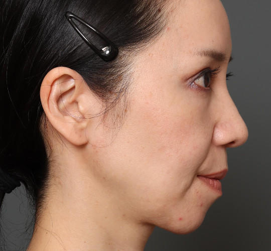 40代女性のチークリフト・フェイスリフト Before 症例写真