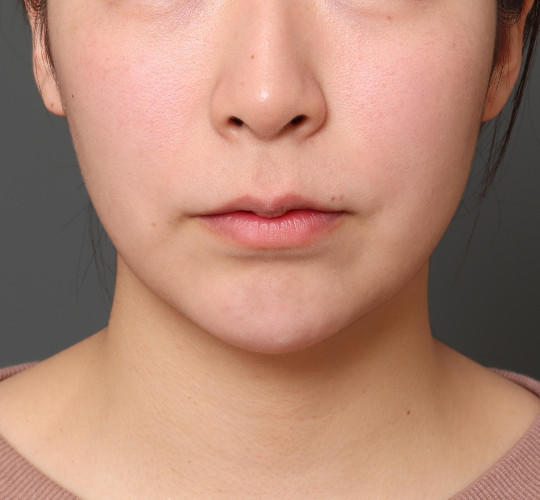 20代女性の鼻の整形 Before 症例写真