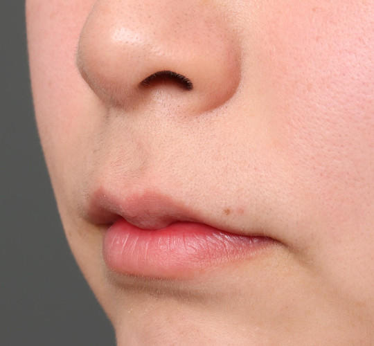 20代女性の人中短縮（リップリフト） Before 症例写真