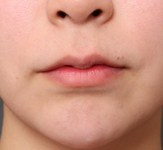 20代女性の人中短縮（リップリフト） Before 症例写真