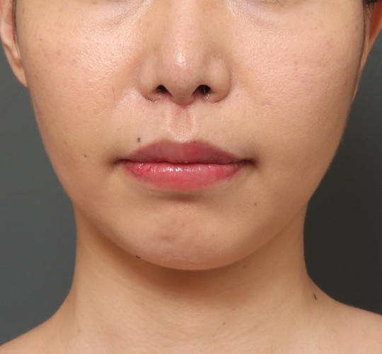 30代女性の鼻の整形 After 症例写真