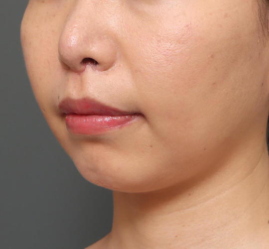 30代女性の人中短縮（リップリフト） After 症例写真