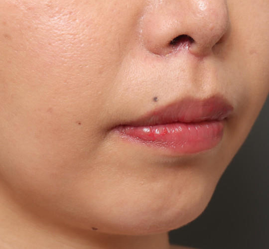 30代女性の人中短縮（リップリフト） After 症例写真