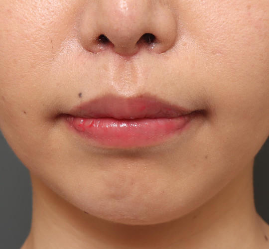 30代女性の人中短縮（リップリフト） After 症例写真