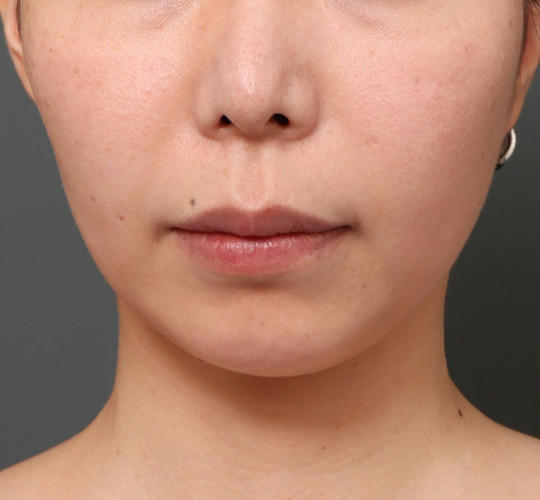 30代女性の鼻の整形 Before 症例写真