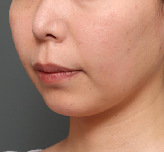 30代女性の人中短縮（リップリフト） Before 症例写真