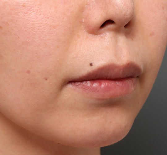 30代女性の人中短縮（リップリフト） Before 症例写真