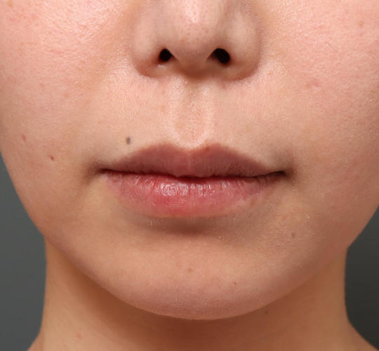 30代女性の人中短縮（リップリフト） Before 症例写真