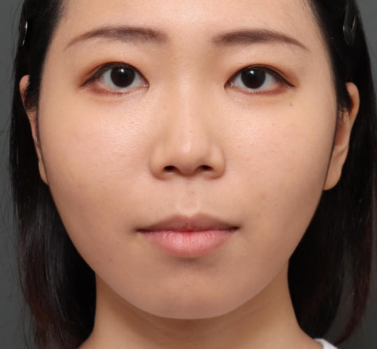 20代女性のメーラーファット除去 After 症例写真