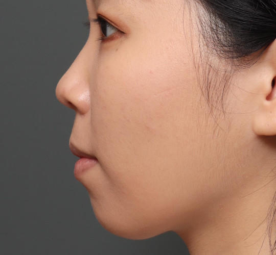 20代女性のメーラーファット除去 After 症例写真