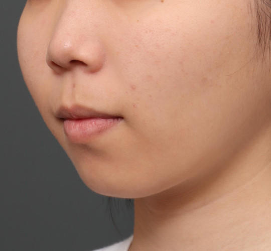 20代女性のメーラーファット除去 After 症例写真