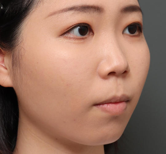 20代女性のVOVリフトプレミアム After 症例写真