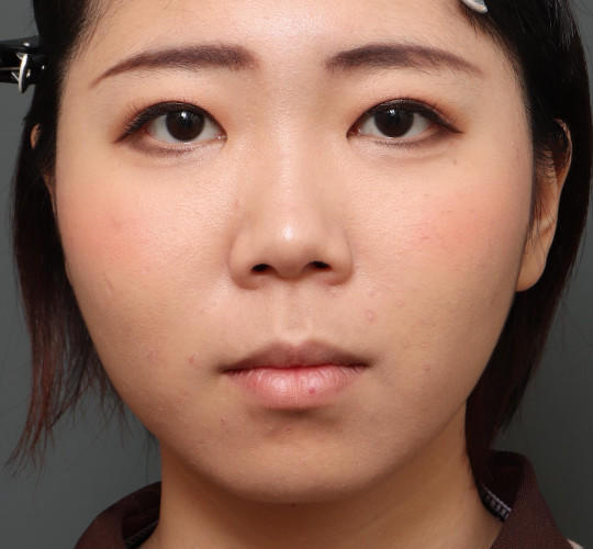 20代女性のメーラーファット除去 Before 症例写真